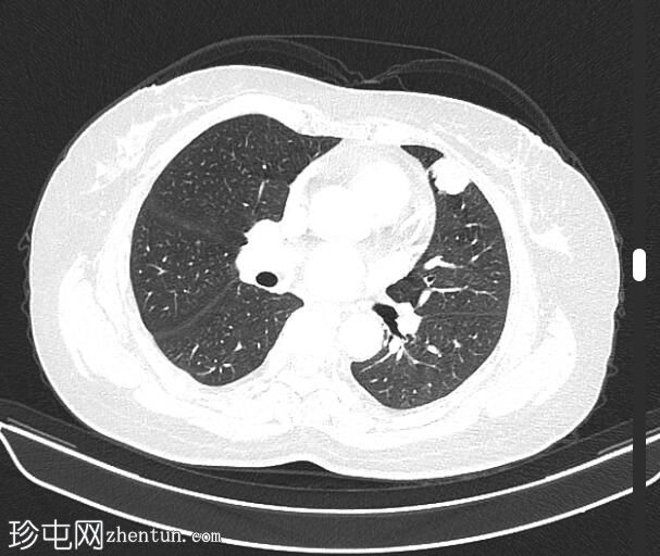 肺转移性黑色素瘤