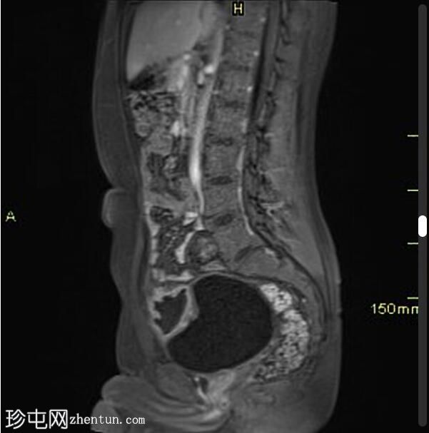 感染性脐尿管囊肿