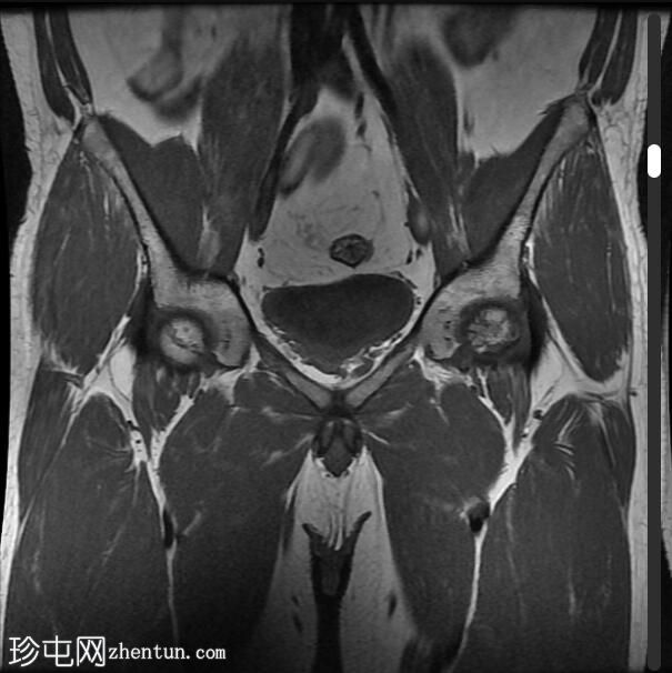 双股骨头缺血性坏死