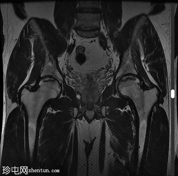 双股骨头缺血性坏死