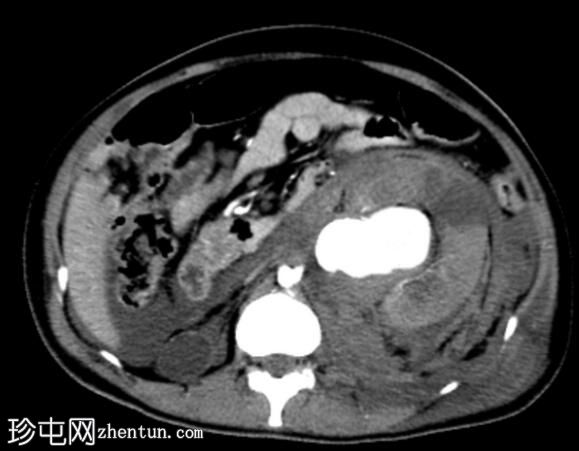肾动脉损伤 - 外伤后
