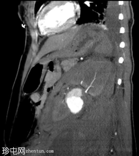 肾动脉损伤 - 外伤后