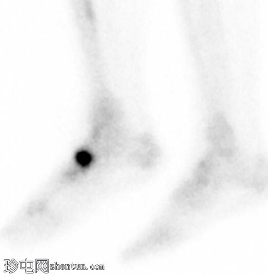 舟骨应力性骨折（骨扫描）