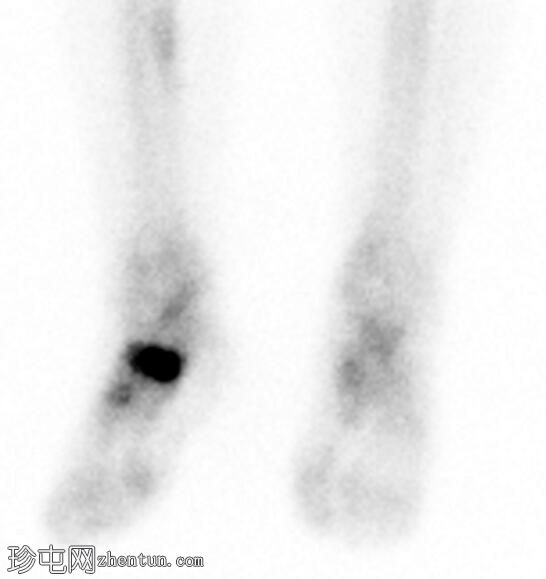 舟骨应力性骨折（骨扫描）