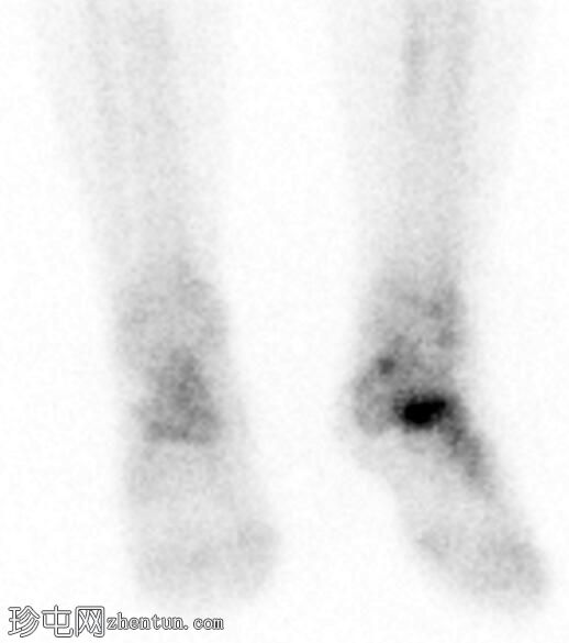 舟骨应力性骨折（骨扫描）