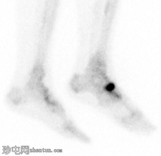 舟骨应力性骨折（骨扫描）