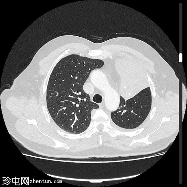 继发于肺门肿块的左上叶塌陷