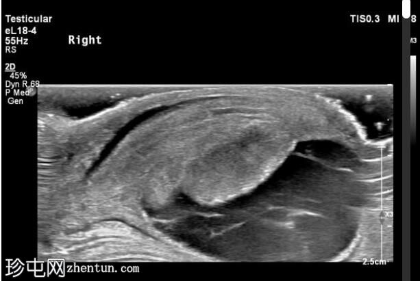 围产期睾丸扭转