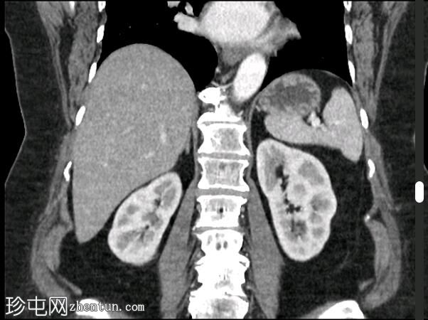 左肾假瘤（Bertin突出柱）