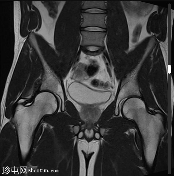 股直肌异位骨化