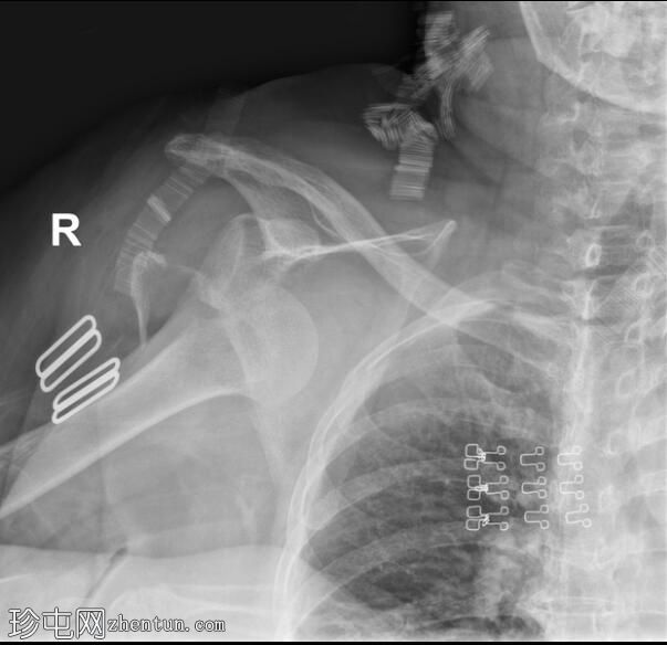 肩关节脱位（胸部X光检查）