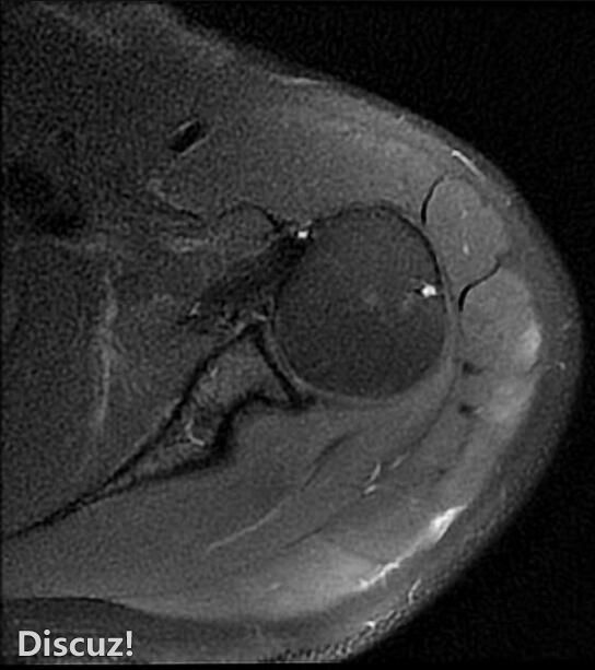 肩锁关节损伤 - II 型 (MRI)