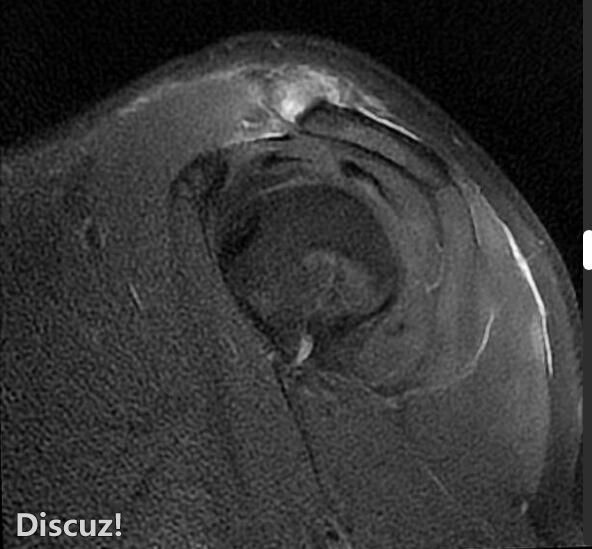 肩锁关节损伤 - II 型 (MRI)