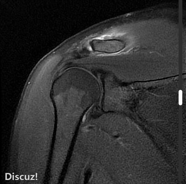 肩锁关节损伤 - II 型 (MRI)