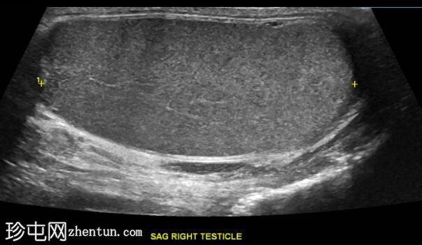 继发于附睾炎的睾丸梗塞