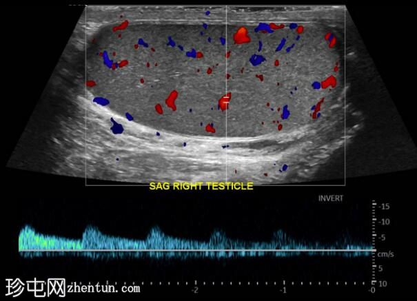 继发于附睾炎的睾丸梗塞