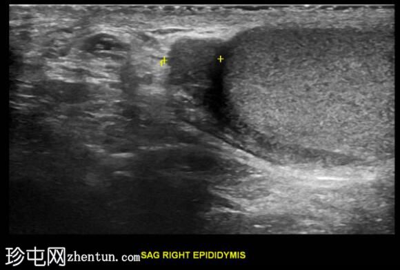 继发于附睾炎的睾丸梗塞