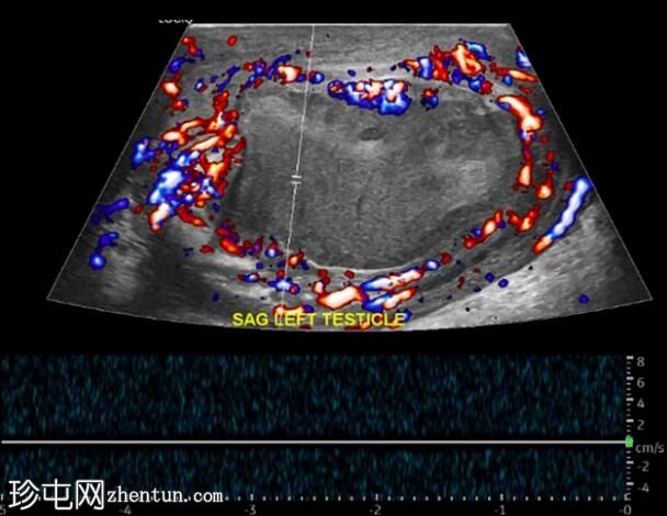 继发于附睾炎的睾丸梗塞