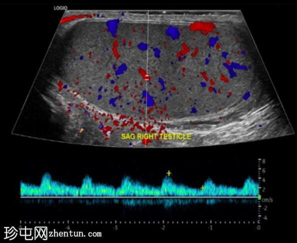 继发于附睾炎的睾丸梗塞