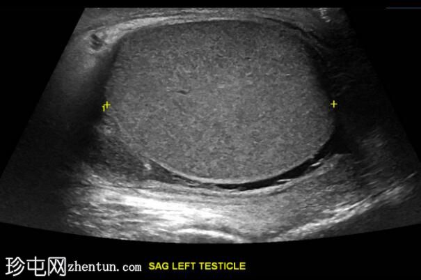 继发于附睾炎的睾丸梗塞