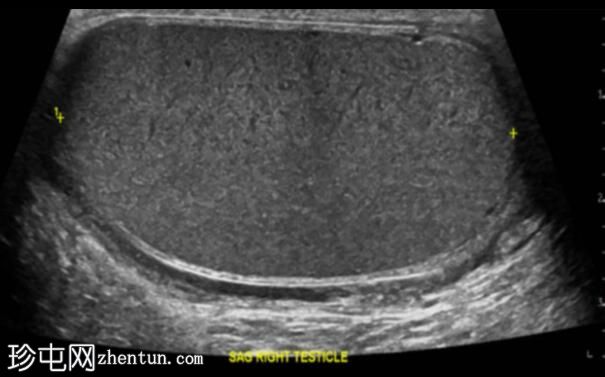 继发于附睾炎的睾丸梗塞