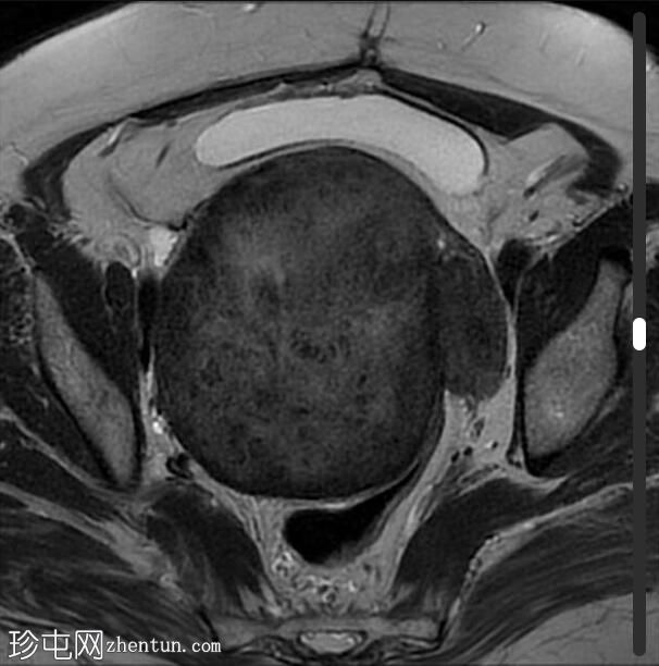 巨大浆膜下子宫肌瘤