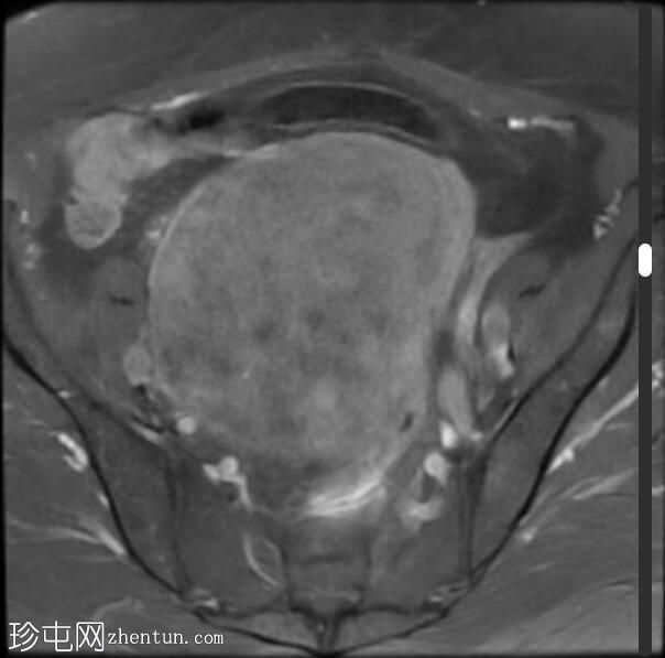 巨大浆膜下子宫肌瘤
