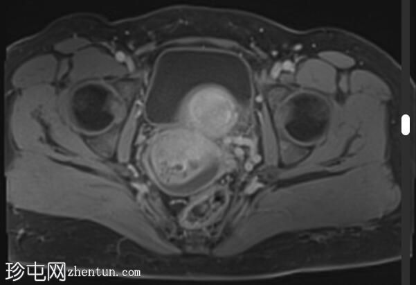 子宫内膜异位症-蘑菇帽征
