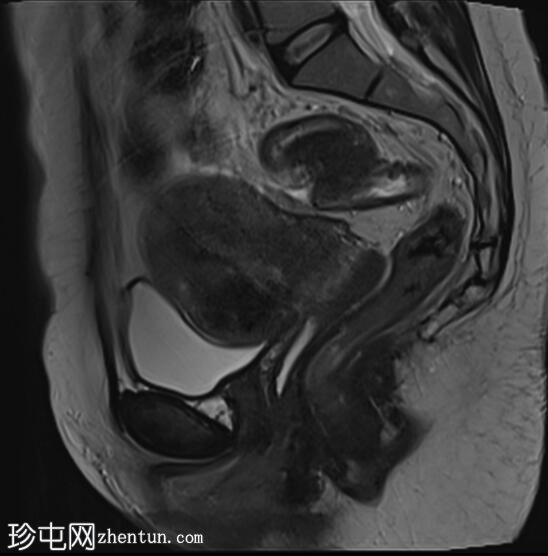 子宫内膜异位症-蘑菇帽征