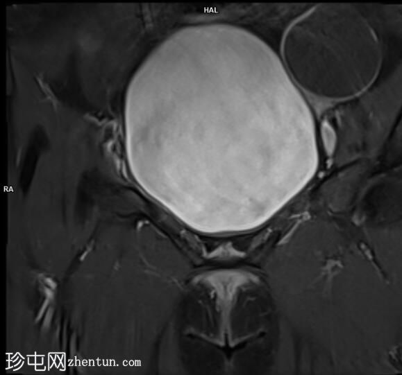 子宫内膜异位症显示扩散受限