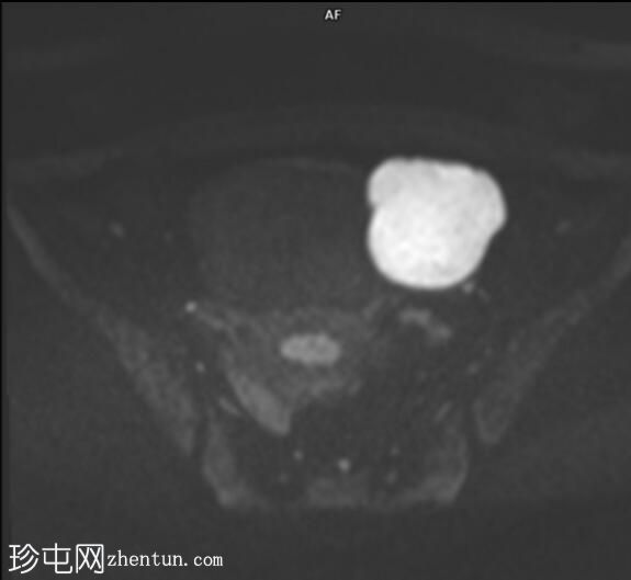 子宫内膜异位症显示扩散受限