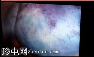 怀孕期间卵巢囊肿扭转