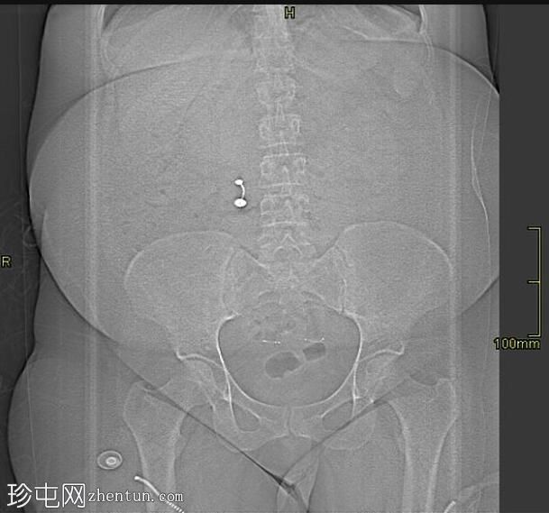 ESSURE 灭菌线圈