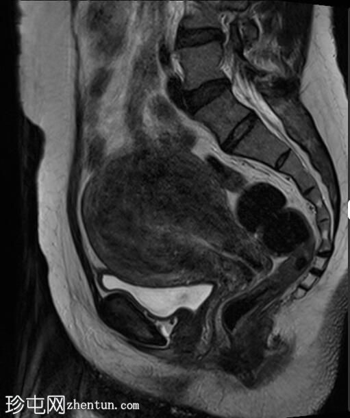 弥漫性子宫腺肌病