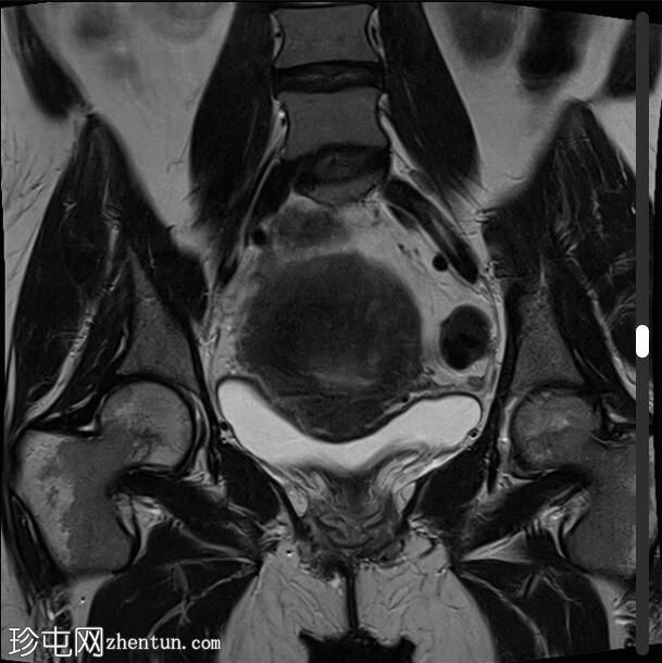 弥漫性子宫腺肌病