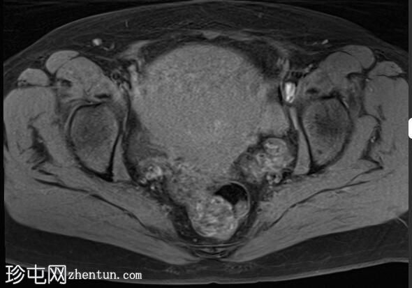 弥漫性子宫腺肌病