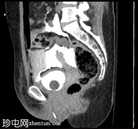 腹膜内膀胱破裂