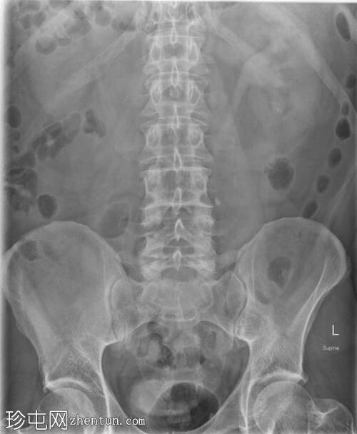 输尿管结石和肾积水（X 射线）