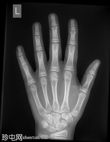 青枝骨折 - 手指