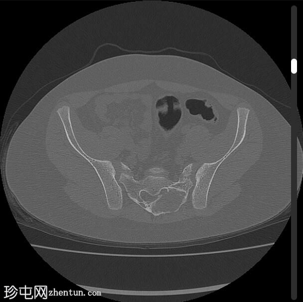 动脉瘤样骨囊肿-骶骨