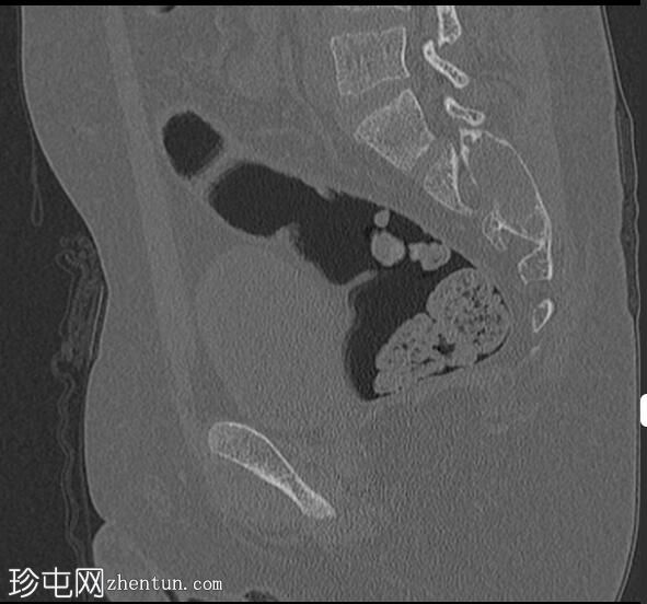 动脉瘤样骨囊肿-骶骨