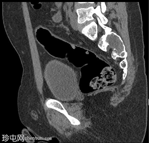 动脉瘤样骨囊肿-骶骨