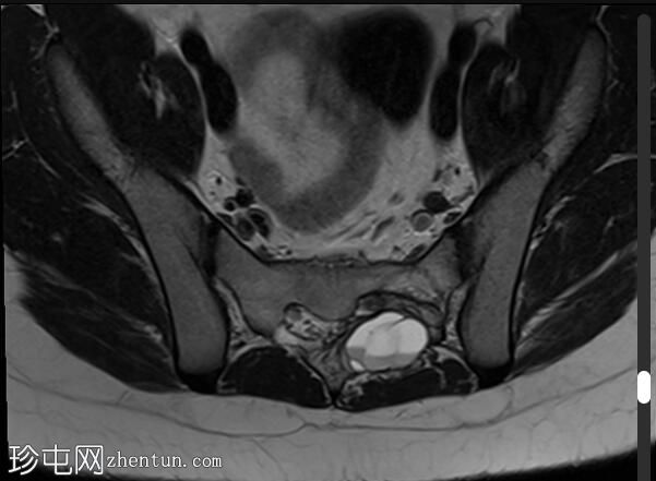 动脉瘤样骨囊肿-骶骨