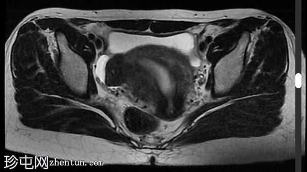 局灶性子宫腺肌病