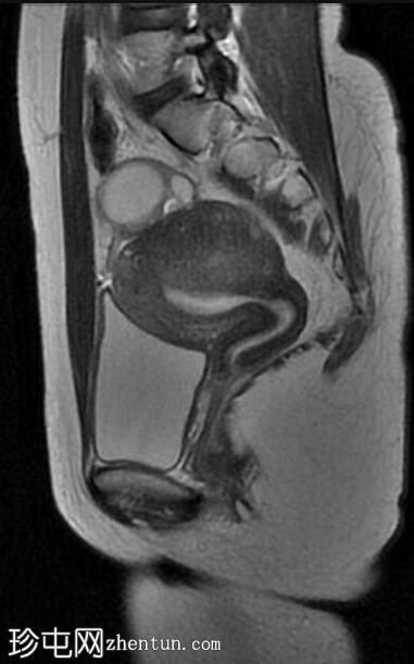 局灶性子宫腺肌病