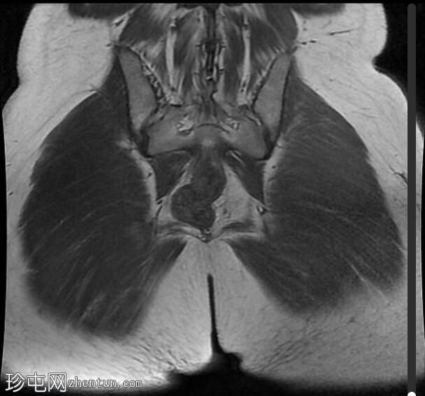 局灶性子宫腺肌病