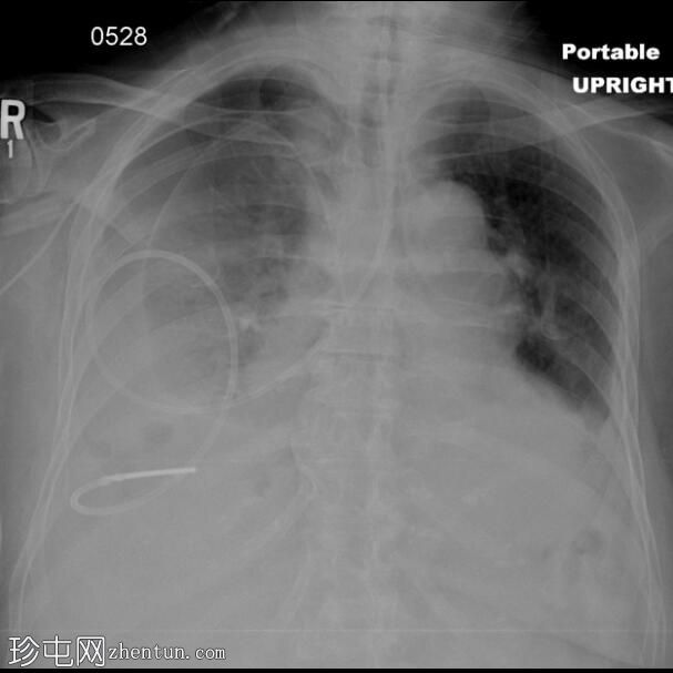 气胸右侧胸膜腔饲管