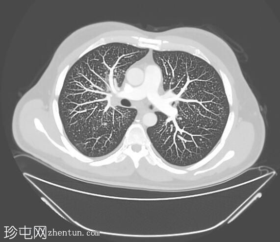 肺腺癌伴粟粒状肺转移