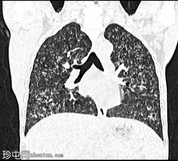 小儿播散性结核病