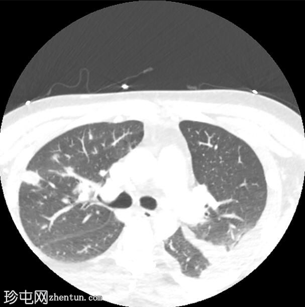 勒米埃尔综合征